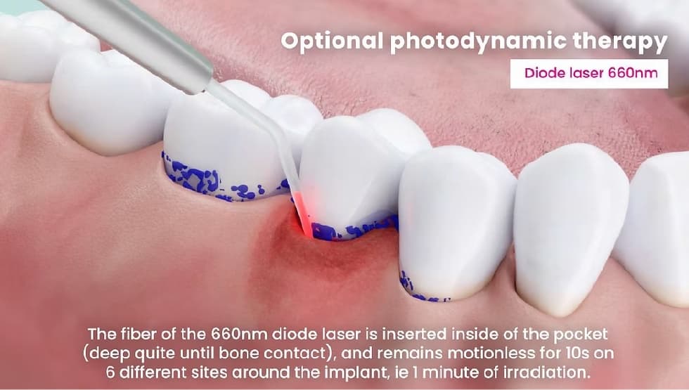 photodynamic therapy procedure image