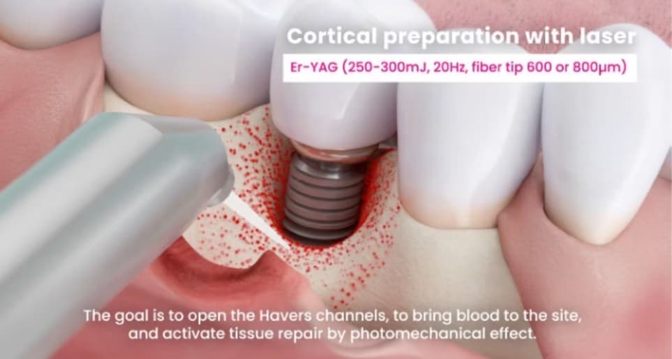 cortical bone treatment image