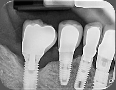 early peri-implantitis case