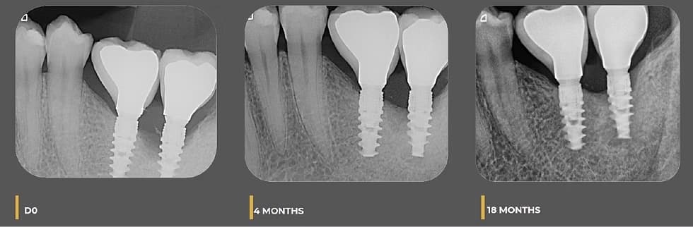 moderate peri-implantitis case
